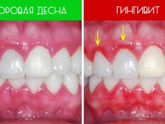 Как выглядит гингивит