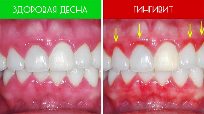 Лечение воспаленных десен и зубов thumbnail