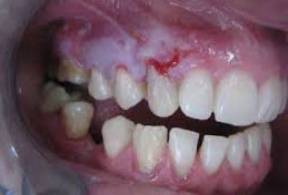 Ожог десны после лечения зуба фото thumbnail