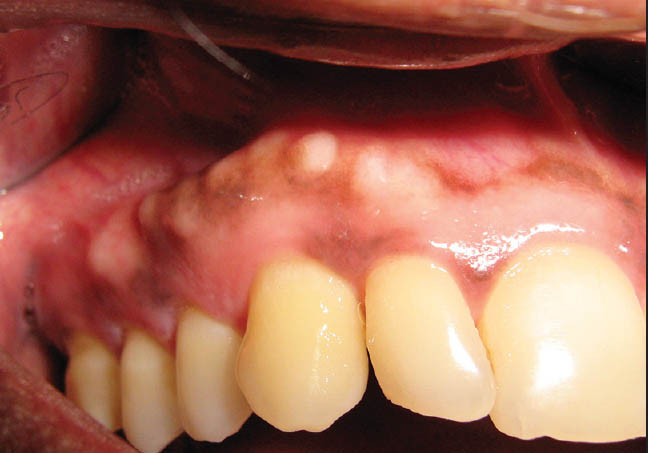 Шишка на десне у зуба у ребенка лечение thumbnail