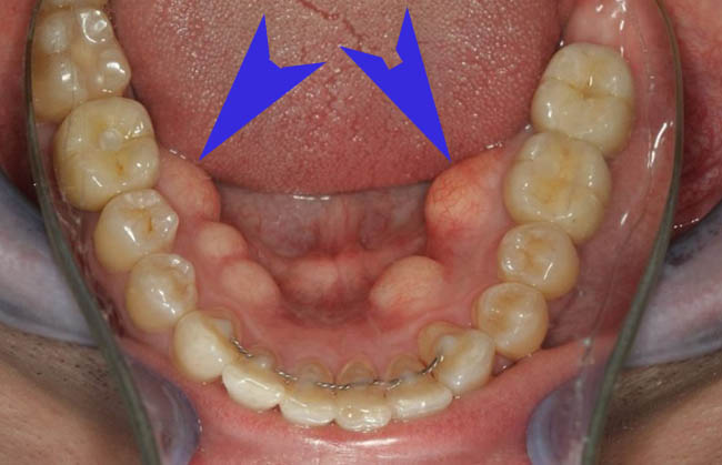Экзостоз в стоматологии