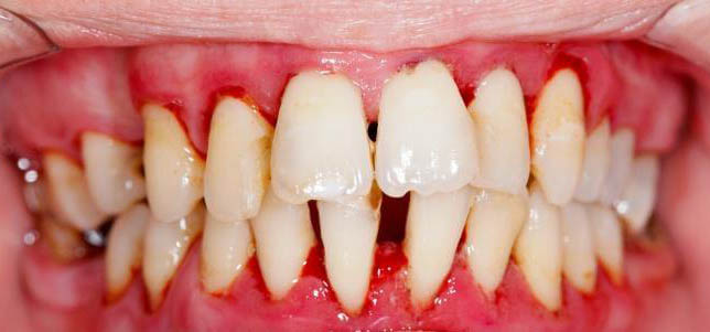 Болит между зубами или сам зуб thumbnail