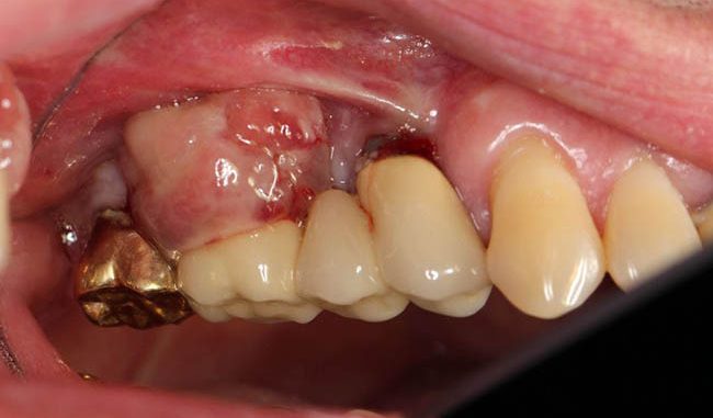 Нарыв над зубом на десне лечение в домашних thumbnail