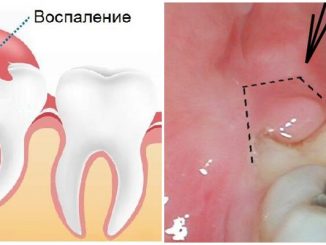 Воспаление капюшона зуба мудрости