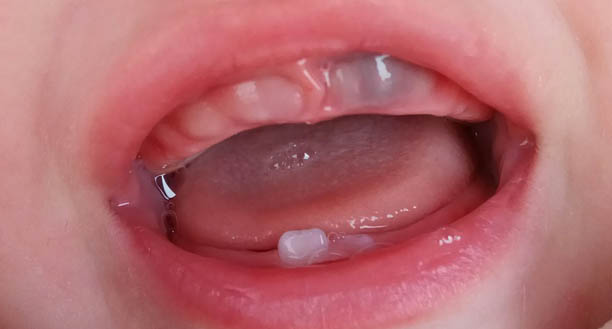 У ребенка опухли десна где зубы и температура 3 года thumbnail