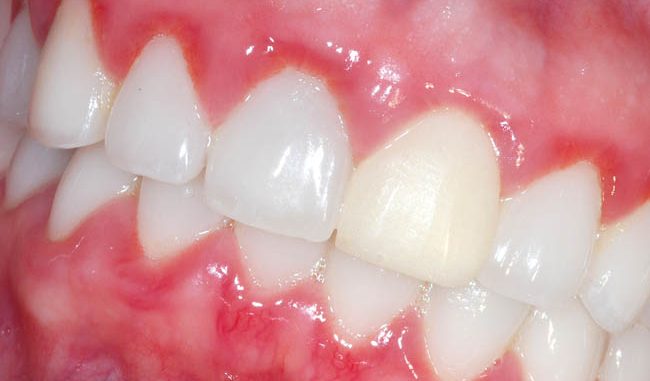 Зубное воспаление чем полоскать thumbnail