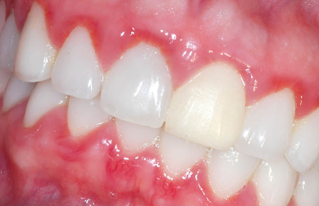 Болит десна над передним зубом при нажатии thumbnail
