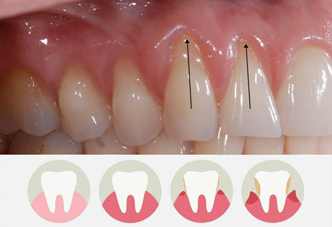 Десны оголяют зубы причины лечение народными средствами thumbnail