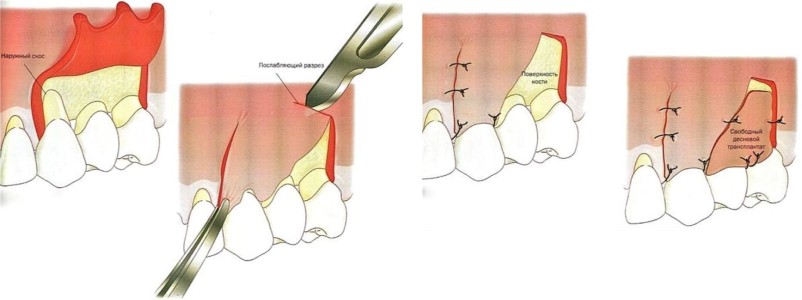 При воспалении десен болят зубы thumbnail