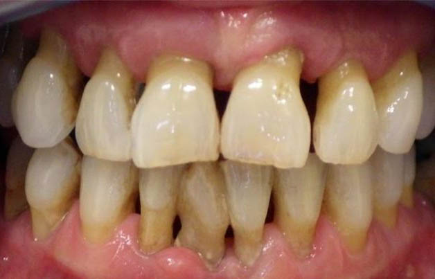 Болезни зубов и десен симптомы и лечение thumbnail