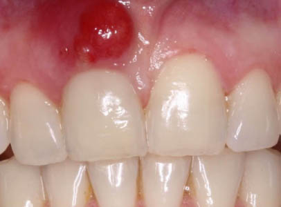 Больно ли делать укол в десну перед лечением зуба thumbnail