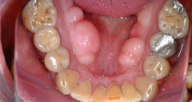 Гематома шишка после удаления зуба thumbnail