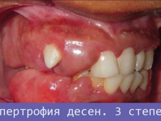 Гипертрофия десен 3 степень