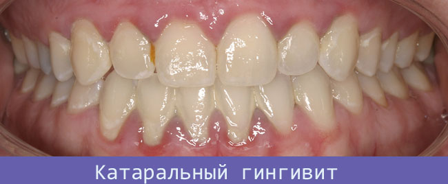 Зубы поднялась десна лечение thumbnail