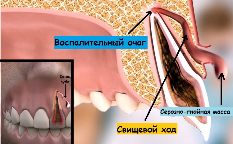 Свищевой ход зуб лечение thumbnail