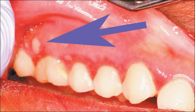 Белое пятно на десне после лечение зуба thumbnail