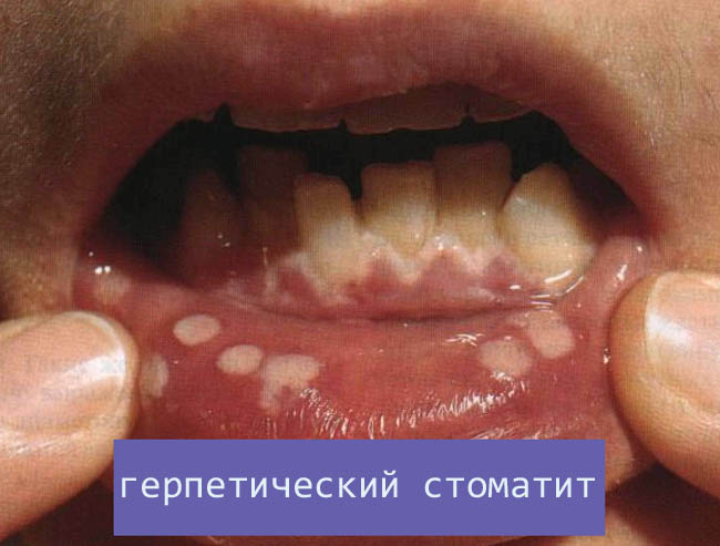 Лечение стоматита гингивита у взрослых thumbnail