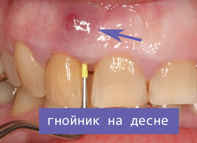 Абсцесс зуба лечение в домашних условиях