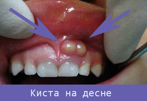 Белые точки на десне над зубом не болит thumbnail