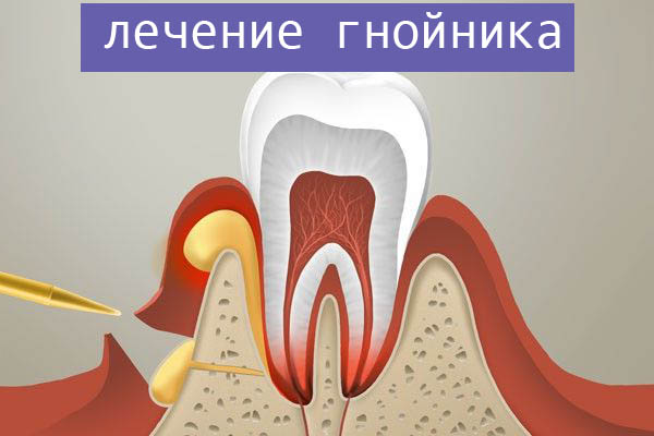 Гнойник на десне после удаления зуба лечение в домашних условиях thumbnail