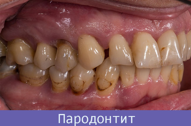 Поднятие десны над зубом лечение thumbnail