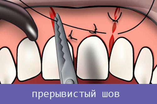 Через сколько снимают швы после удаления зуба