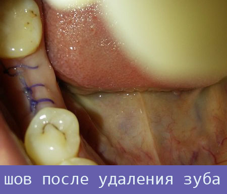 Болит зуб после надреза десны thumbnail