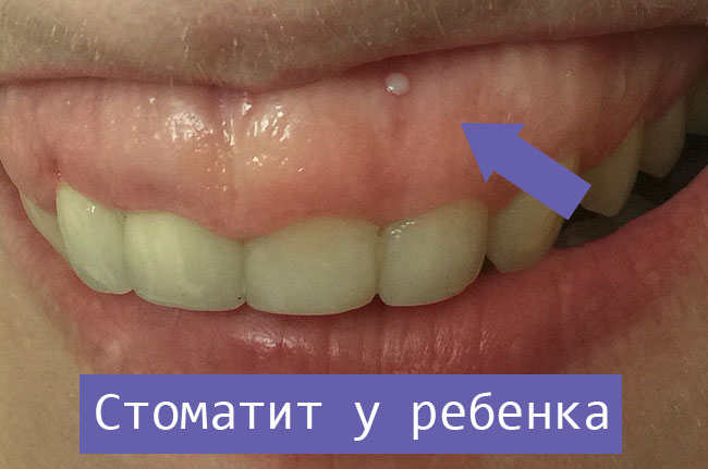 Болит зуб белое пятно на десне thumbnail