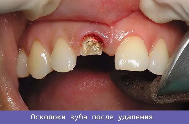 Осколоки зуба после удаления