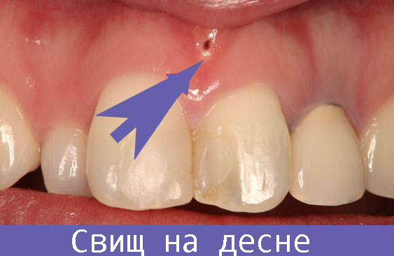 Лечение молочного зуба свищ thumbnail