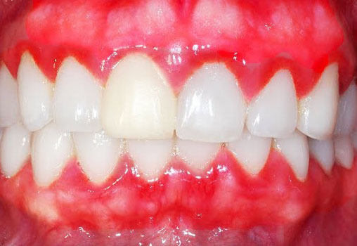 Шатаются нижние передние зубы народные средства лечение thumbnail