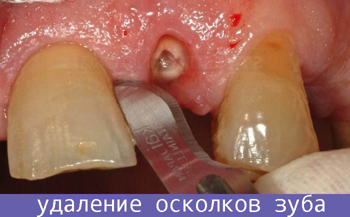 удаление осколков зуба
