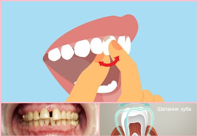 Как вылечить десна зубы шатаются thumbnail