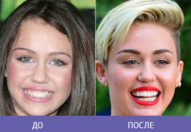Десневая улыбка до и после фото