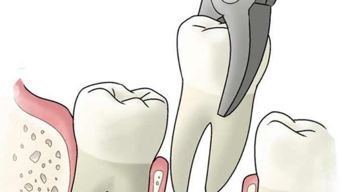 Воспаление десны после удаления зуба лечение народными средствами thumbnail