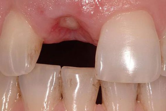 Средства после удаления зуба болит десна thumbnail