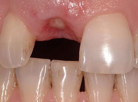 Опухла щека после удаления зуба лечение thumbnail