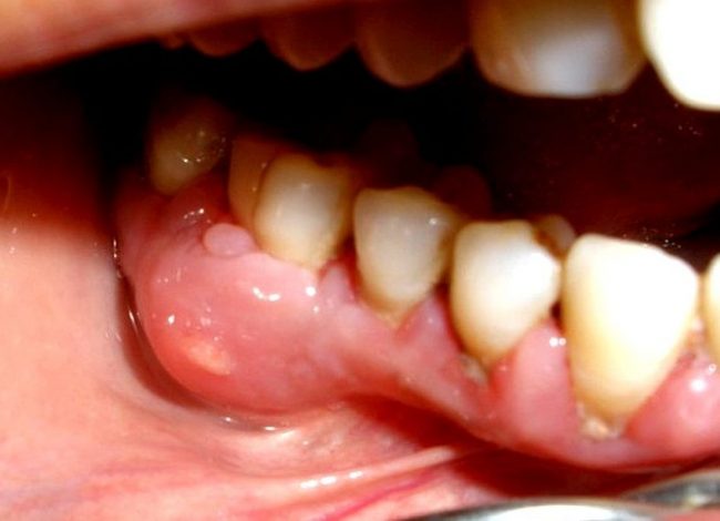 Шишка на десне около зуба – методики лечения образований