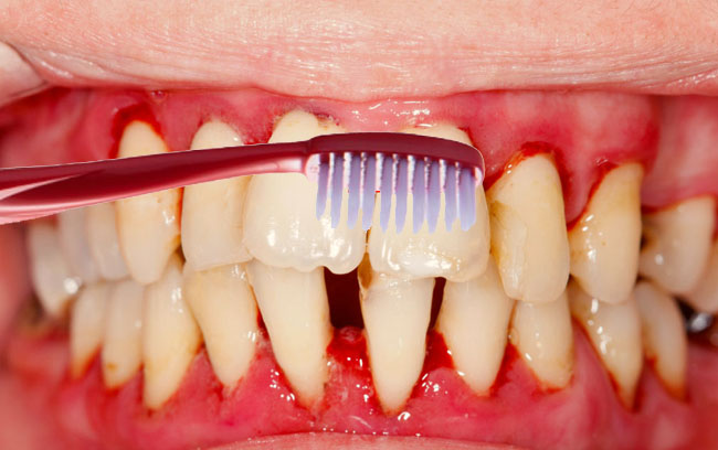 Нарост на десне у ребенка при прорезывании зубов фото
