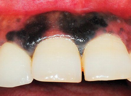 Некроз десны после лечения зуба thumbnail
