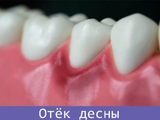 отёк десны