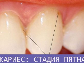Сдадия пятна кариеса