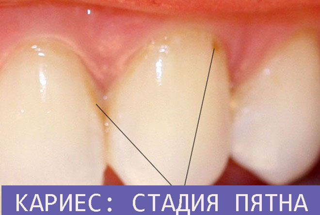 Кариес зубов лечение у десен thumbnail