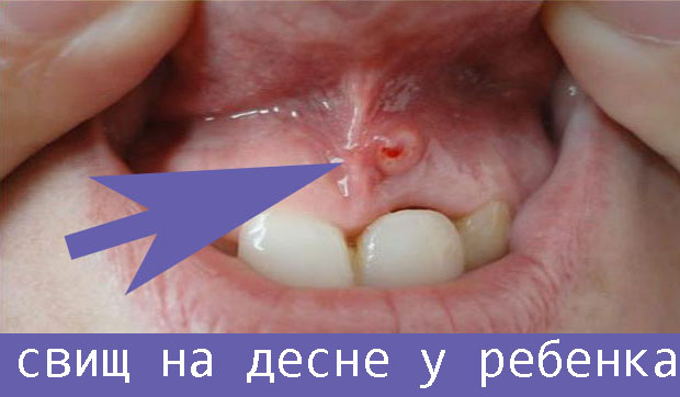 Свищ на десне молочного зуба у ребенка лечение thumbnail