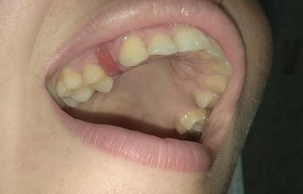 Осколок зуба в десне фото