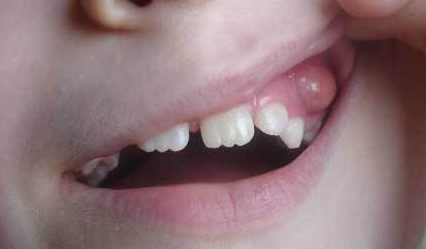 Шишка на зубе у ребенка после лечения thumbnail