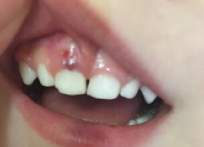 Шишка над зубом у ребенка лечение thumbnail