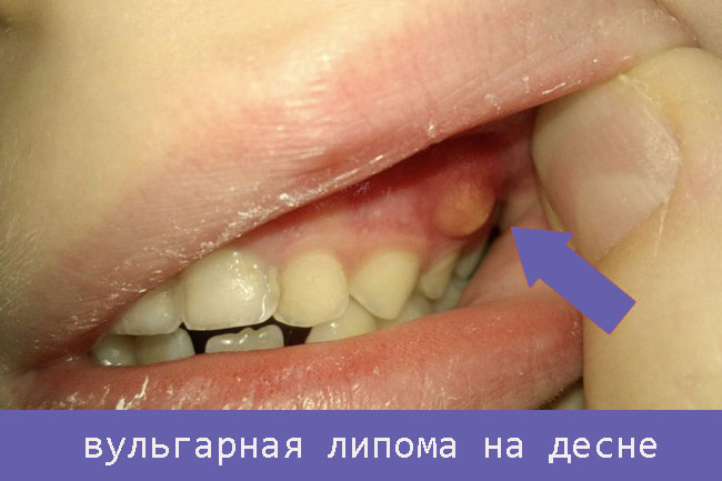 Шишка на десне над зубом не болит у ребенка лечение thumbnail