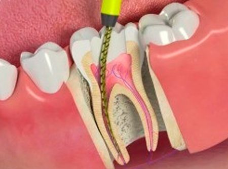 Онемение зубов и воспаление десен thumbnail