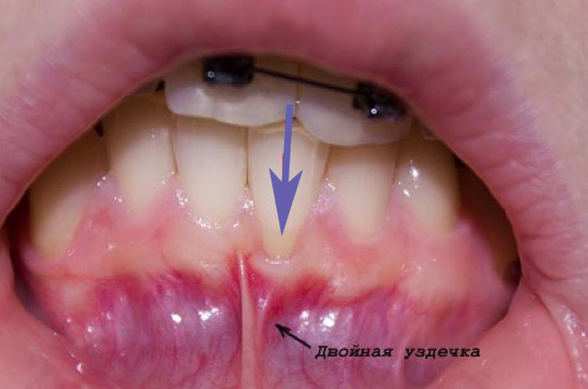 Пластика десны при оголении корня зуба